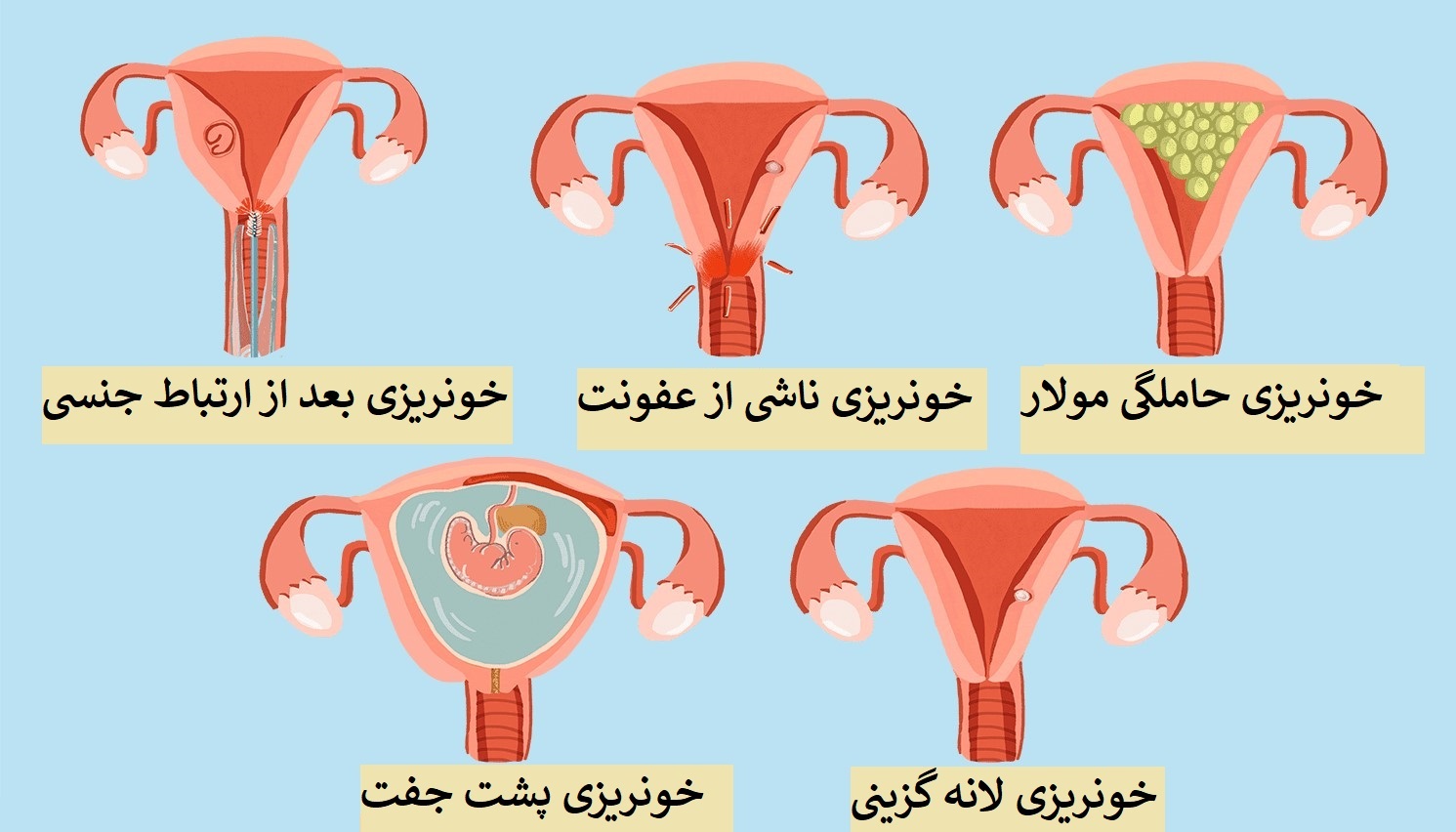 انواع خونریزی در زنان